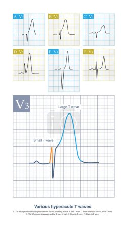 Photo for Under different diseases and pathophysiological conditions, the hyperacute T wave of acute myocardial ischemia can have various forms, characterized by small r wave and large T wave. - Royalty Free Image