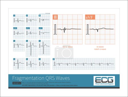 Photo for When the left axis deviation, the maximum QRS potential is located in the upper left quadrant, spanning - 30 , and at the negative side of the  lead axis. The QRS main wave in lead II is negative. - Royalty Free Image