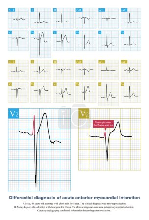 Photo for In case of acute anterior myocardial infarction and slight ST segment elevation in ECG, it is necessary to differentiate it from early repolarization. Follow up troponin and ECG. - Royalty Free Image