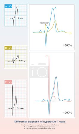 Photo for When the T wave is high, the differential diagnosis of hyperacute T wave is that the patient has chest pain symptoms, and the slope of the initialization part of ST-T is steep. - Royalty Free Image