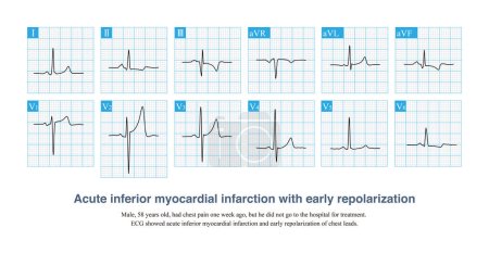 Photo for Early repolarization is mostly a benign ECG change, and ST segment elevation caused by it can sometimes coexist with myocardial infarction. - Royalty Free Image