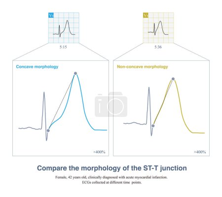 Photo for Sometimes, evolution is found on the ECG of a patient with acute myocardial infarction, depending on the time point or lead of the ST-segment elevation. - Royalty Free Image