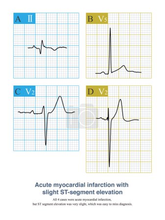 Photo for In AMI, if the amplitude of ST segment elevation is less than 1mm, it is called slight ST segment elevation myocardial infarction, which is easily misdiagnosed as early repolarization - Royalty Free Image