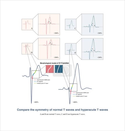 Foto de Vale la pena señalar que muchos libros de texto electrocardiográficos creen que las ondas T hiperagudas son simétricas. De hecho, no son simétricas.. - Imagen libre de derechos