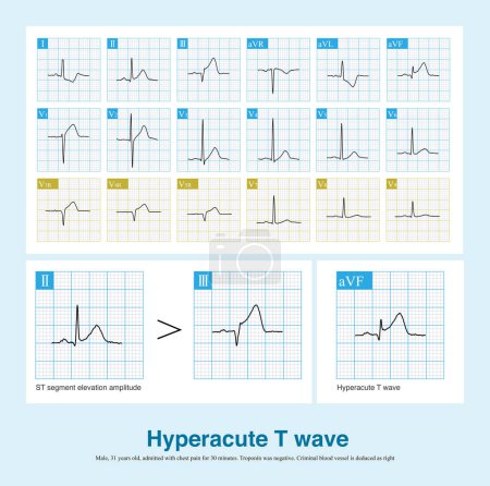 Photo for In the early stage of acute myocardial infarction, T wave is upright, with increased amplitude and symmetry, with or without ST segment elevation, which is called hyperacute T wave. - Royalty Free Image