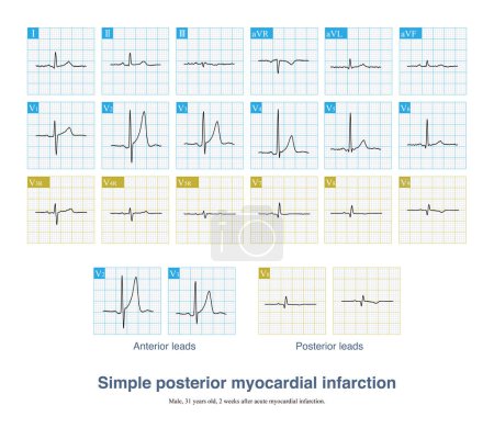 Photo for In case of simple posterior myocardial infarction, the amplitude of R wave in lead V2-V3 is increased, and the T wave is tall, which is easy to be misdiagnosed as acute anterior myocardial infarction. - Royalty Free Image