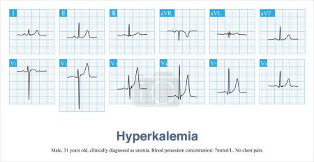 Photo for High-sharp T waves of hyperkalemia need to be differentiated from hyperacute T waves, and patients usually have no chest pain, elevated potassium, no ST elevation, and a narrow base of the T wave. - Royalty Free Image
