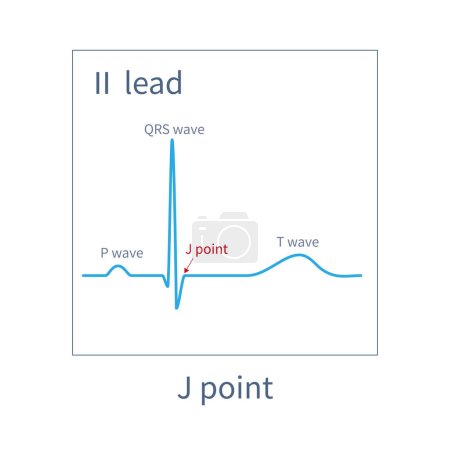 Photo for On the ECG, J point is the junction point between the end point of the QRS wave and the initiation of the ST segment, and is the turning point of ventricular depolarization and repolarization. - Royalty Free Image