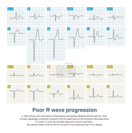 Téléchargez les photos : Une mauvaise progression de l'onde R peut être observée non seulement dans le syndrome coronarien aigu, mais aussi dans la cardiopathie non ischémique, qui est facilement diagnostiquée à tort comme un infarctus du myocarde.. - en image libre de droit