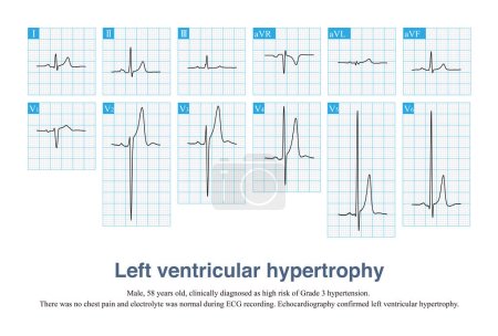 Photo for Sometimes, left ventricular hypertrophy with tall T waves is easily misdiagnosed as hyperkalemia and hyperacute T waves, and ECG needs to be carefully identified in combination with clinic. - Royalty Free Image