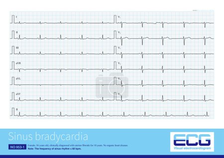 Téléchargez les photos : La bradycardie sinusale se réfère à la fréquence des impulsions émises par le nœud sinusal à moins de 60 battements par minute, et l'ECG montre un rythme sinusal lent. - en image libre de droit