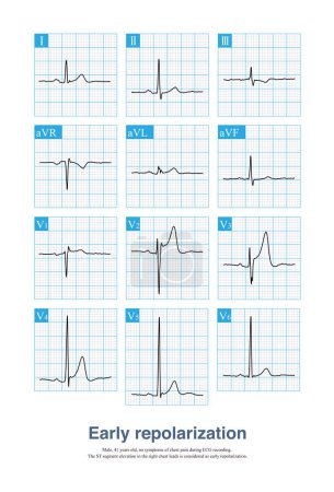Photo for The ECG characteristic change of early repolarization is J point and ST segment elevation, which is easy to be misdiagnosed as acute myocardial infarction, especially when the patient has symptoms. - Royalty Free Image
