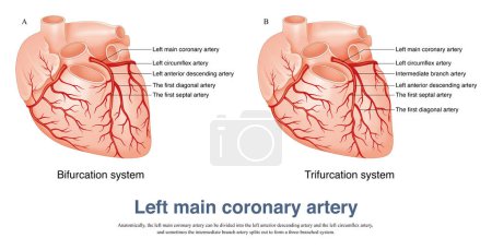 La arteria coronaria principal izquierda se puede dividir en la arteria descendente anterior izquierda y la arteria circunfleja izquierda, y a veces la arteria de rama intermedia..