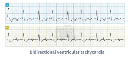 La taquicardia ventricular bidireccional es un tipo de arritmia maligna. La polaridad de la onda principal del QRS se alterna de latido a latido, y es fácil degenerar en fibrilación ventricular.