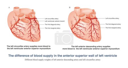 Foto de In different individuals, the left anterior descending artery and the left circumflex artery send out different branches to supply blood to the anterior superior wall of the left ventricle. - Imagen libre de derechos