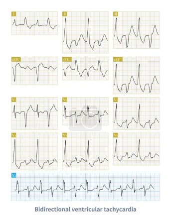 Photo for Bidirectional ventricular tachycardia is a kind of malignant arrhythmia. The polarity of QRS main wave alternates from beat to beat, and it is easy to degenerate into ventricular fibrillation. - Royalty Free Image