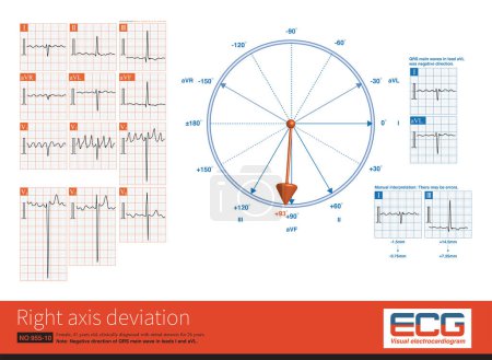 Téléchargez les photos : Long term mitral stenosis leads to pulmonary hypertension, which eventually leads to increased right ventricular afterload and right ventricular hypertrophy.ECG showed right axis deviation. - en image libre de droit