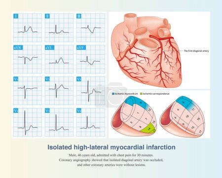 Photo for Isolated occlusion of diagonal artery can lead to isolated high lateral myocardial infarction, and ST segment elevation in leads I and aVL of ECG. - Royalty Free Image