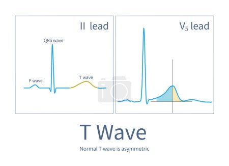 Téléchargez les photos : The T wave is the ventricular repolarization wave. The normal T wave is asymmetric: the ascending branch is slow and the descending branch is steep. - en image libre de droit