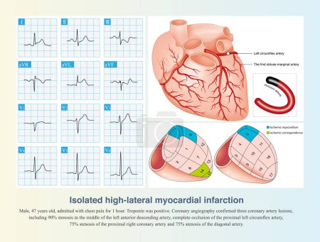 Photo for Isolated occlusion of left circumflex artery can lead to isolated high lateral myocardial infarction, and ST segment elevation in leads I and aVL of ECG. - Royalty Free Image