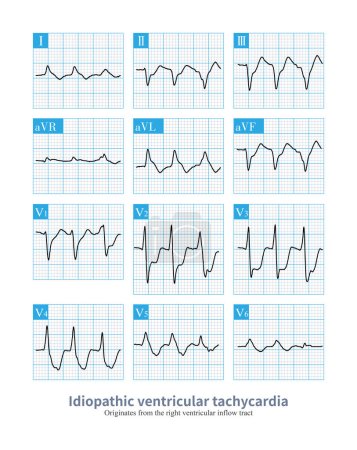 Photo for The electrocardiogram is an idiopathic ventricular tachycardia originating from the right ventricular inflow tract, a benign ventricular tachycardia. - Royalty Free Image