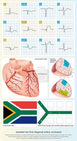 Photo for When the isolated first diagonal artery is occluded, ECG can show ST segment elevation in leads I, aVL, and V2, and ST segment depression in lead III, and the layout resembles the South African flag. - Royalty Free Image