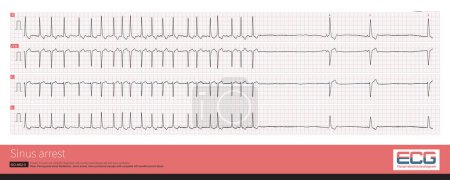 Foto de ECG of a patient with sick sinus syndrome. After a paroxysmal atrial fibrillation attack, there was a long time of sinus arrest, and the ventricular arrest time was close to 4s. - Imagen libre de derechos