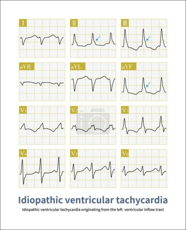 Foto de This case of ventricular tachycardia originated from the left ventricular inflow tract, which is a benign idiopathic ventricular tachycardia. - Imagen libre de derechos