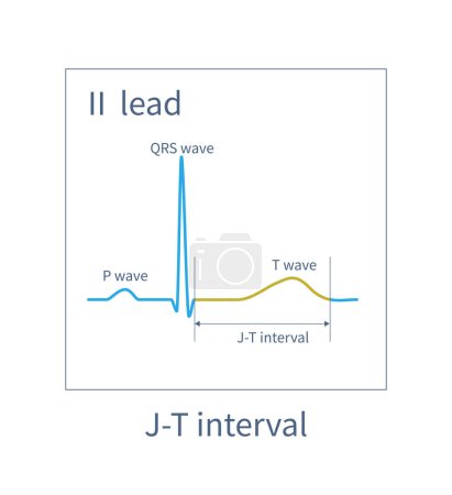 Téléchargez les photos : The JT interval is the time interval from the J point or the start of the J wave to the end of the T wave.It represents the total time of ventricular repolarization. - en image libre de droit