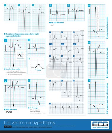 Photo for Left ventricular hypertrophy can cause a series of ECG changes such as left axis deviation, atrial abnormality, prolongation of QRS duration and ST-T change. - Royalty Free Image
