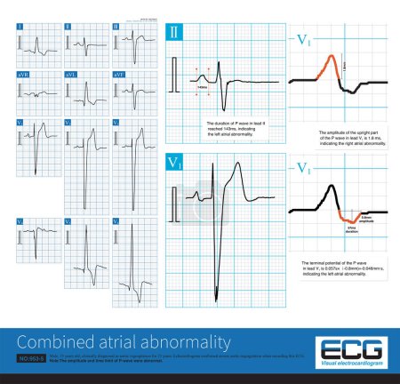 Photo for Sometimes, we can use lead V1 to measure the interval and amplitude of P wave, and simultaneously diagnose left atrial abnormality and right atrial abnormality, that is, biatrial abnormality. - Royalty Free Image