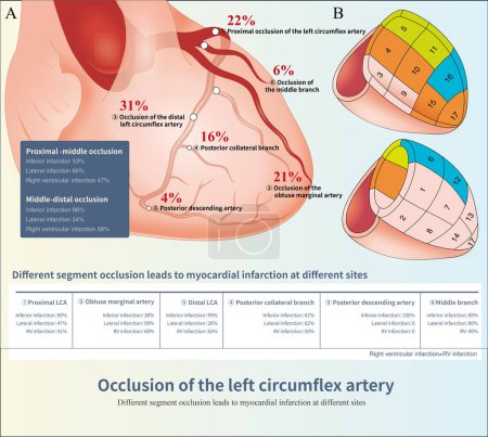 Photo for The left circumflex arterysends out different branch arteries, different segments or branch occlusion, causing myocardial infarction in different sites. - Royalty Free Image
