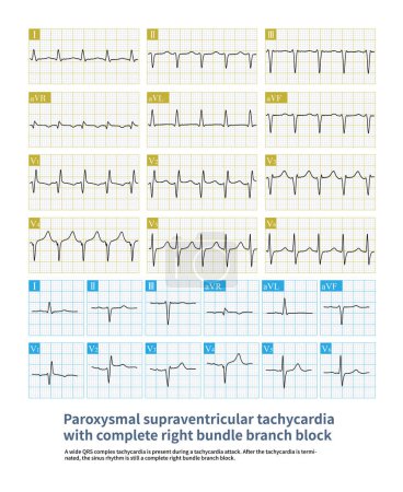 Photo for Sometimes, when supraventricular tachycardia is combined with bundle branch block, the QRS time limit  120 ms, resulting in wide QRS wave tachycardia. - Royalty Free Image