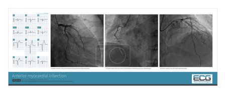 Photo for In one young man with extensive anterior myocardial infarction, coronary angiography confirmed occlusion of the left anterior descending artery opening, and successful intracoronary stent therapy. - Royalty Free Image