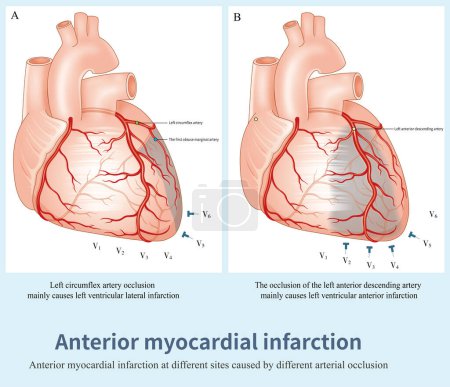 Photo for Left anterior descending artery occlusion causes left ventricular anterior infarction, and left circumflex artery occlusion causes lateral nfarction.The infarction range of the two is different. - Royalty Free Image