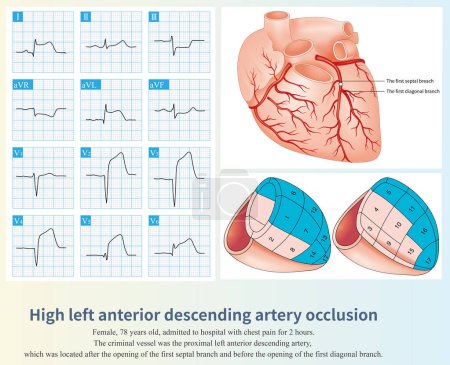 Foto de The occlusion of the proximal left anterior descending artery can cause large area of anterior MI, and the occlusion site can be interpreted according to the ST segment elevation leads of ECG. - Imagen libre de derechos