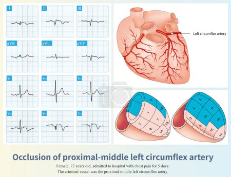 Photo for The occlusion of the proximal and middle left circumflex artery can lead to myocardial infarction in the lateral, inferior and posterior walls, with a large infarction area. - Royalty Free Image