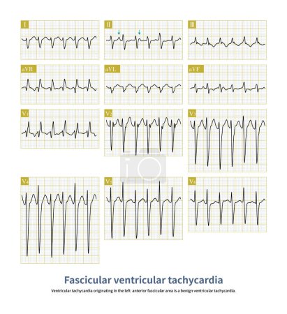 Foto de Idiopathic ventricular tachycardia, if originating from the left anterior fascicular region, it is similar to the right bundle branch block pattern with right axis deviation. - Imagen libre de derechos