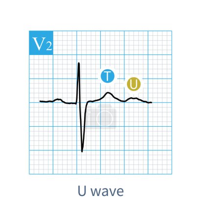 Téléchargez les photos : On ECG, U wave is a low wave after T wave, and its mechanism is still unclear. It may be an electromechanical feedback wave.It is easy to recognize when the heart rate is slow. - en image libre de droit