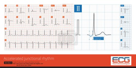 Téléchargez les photos : Ectopic beats originate from the atrioventricular junctional region. The PR interval  is usually less than 120ms, the P-wave is inverted, and the QRS waveform is supraventricular pattern. - en image libre de droit