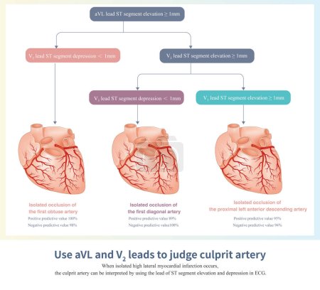 Foto de When the ST segment of leads I and aVL is elevated, the culprit vessels can be the left anterior descending artery, the obtuse marginal artery, and the diagonal artery. - Imagen libre de derechos