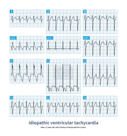 Photo for Ventricular tachycardia originating in the left posterior fascicular region is a benign ventricular tachycardia.QRS wave  is simila rcomplete RBBB combined with left anterior fascicular block. - Royalty Free Image