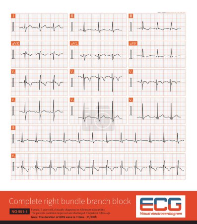 Téléchargez les photos : In 2009, American AHA ECG guidelines defined children aged 4 to 16 years old, and QRS duration  110ms can be diagnosed as complete right bundle branch block. - en image libre de droit