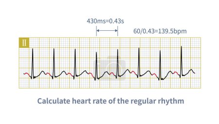 Photo for In daily work, the horizontal 1 mm represents 40 ms of time in the small square of ECG. Therefore, the frequency of cardiac rhythm can be calculated by using the horizontal small square. - Royalty Free Image