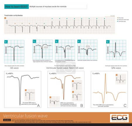 Téléchargez les photos : Ventricular fusion wave is a QRS wave generated by impulses from different sources in the ventricle that jointly excite the ventricle.QRS complex of ventricular fusion wave is variable. - en image libre de droit