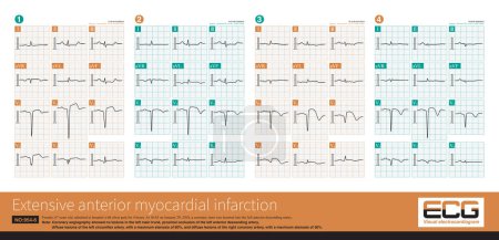 Photo for A 67-year-old patient with acute extensive anterior myocardial infarction showed obvious ST-T evolution on the sequence electrocardiogram during hospitalization. - Royalty Free Image