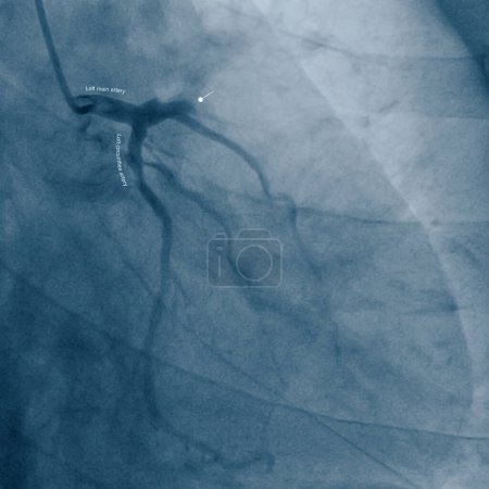 Photo for Male, 31 years old, admitted to hospital for chest pain for 1 hour. Coronary angiography showed complete occlusion of the proximal left anterior descending artery. - Royalty Free Image