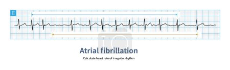 Foto de Atrial fibrillation is a kind of atrial tachyarrhythmia, and the ventricular rate is absolutely irregular.You can calculate the mean cardiac cycle of 10 heartbeats. - Imagen libre de derechos