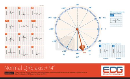 Foto de When the frontal QRS axis is located at +74, the QRS main wave in lead aVL is negative and the highest amplitude of the QRS wave in the limb leads is the  lead. - Imagen libre de derechos