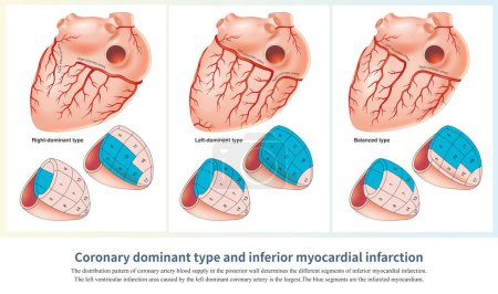 Photo for The inferior infarction caused by the right coronary artery will also affect the RV, while the left circumflex artery will also affect the lateral and posterior wall of the LV. - Royalty Free Image